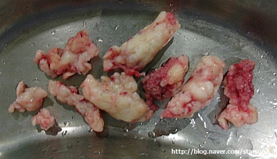 200510myomectomy5cm_starson2.jpg