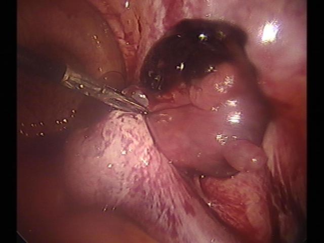 Ectopic(15).jpg