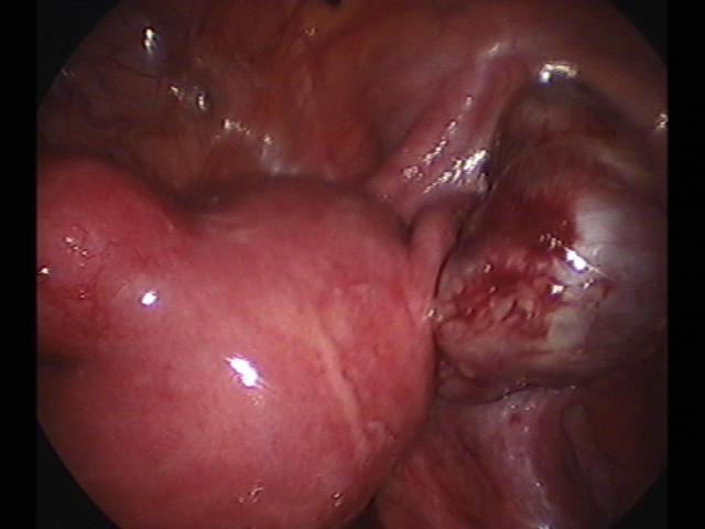 ROC&myomectomy (3).jpg