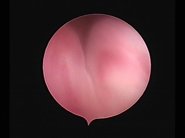 Resectoscopy (3)(22).jpg