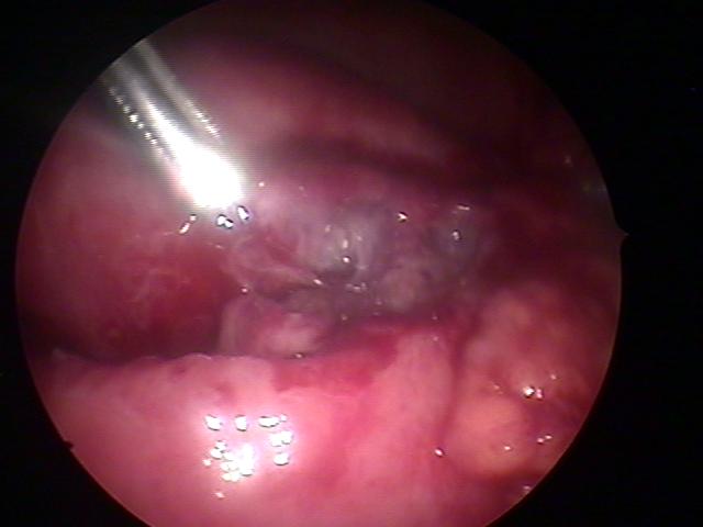 TOA&salphingectomy (2).jpg