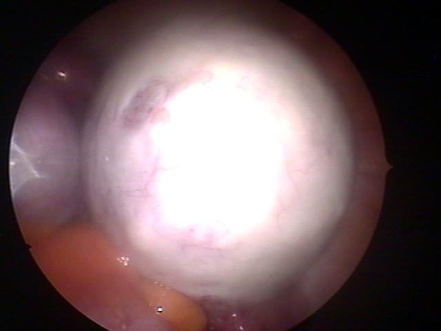 both ovary teratoma (2).jpg