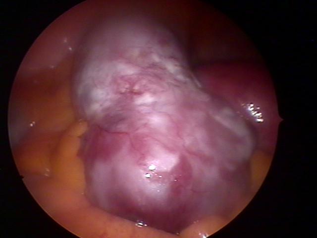 both ovary teratoma (3).jpg