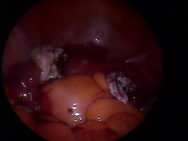 both ovary teratoma (5).jpg