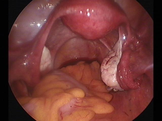 cystectomy (5)(0).jpg