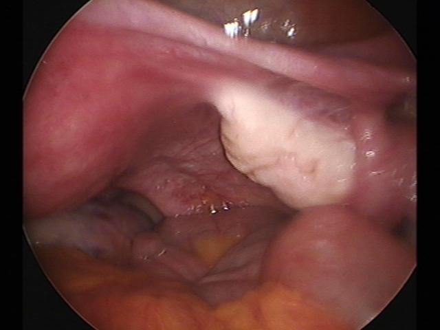 ectopic (2)(3).jpg