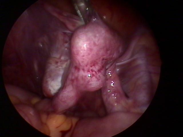 ectopic (3).jpg