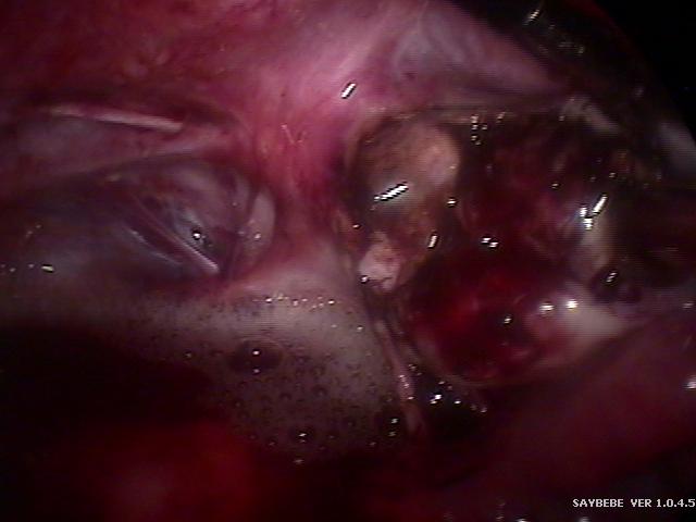 endometrioma (4).jpg