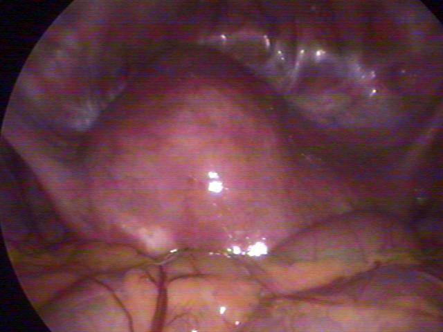 myomectomy (2)(0).jpg