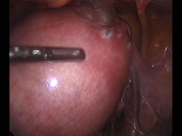myomectomy (2)(12).jpg