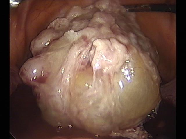 myomectomy (2)(6).jpg