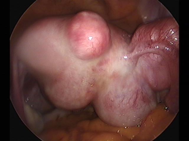 myomectomy (2)(7).jpg