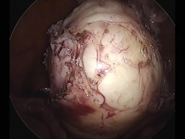 myomectomy (2)(8).jpg