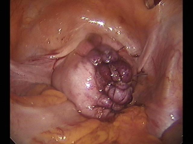 myomectomy (3)(5).jpg