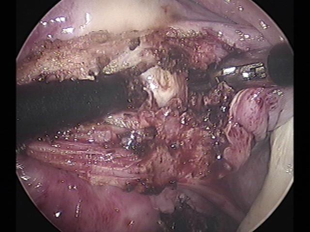 myomectomy (4)(7).jpg