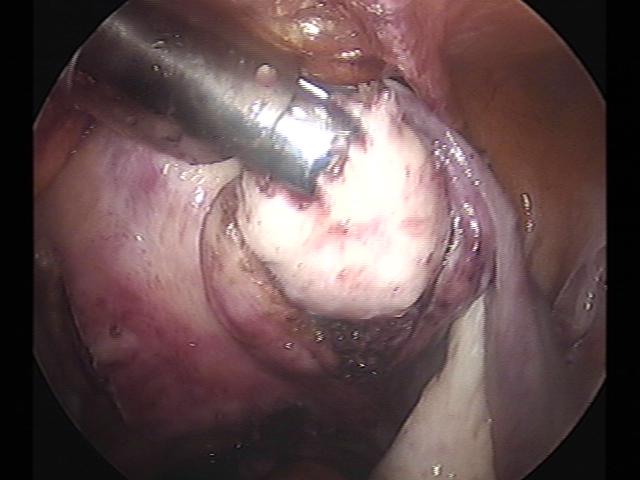 myomectomy (5)(2).jpg