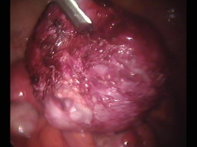 myomectomy (6)(1).jpg