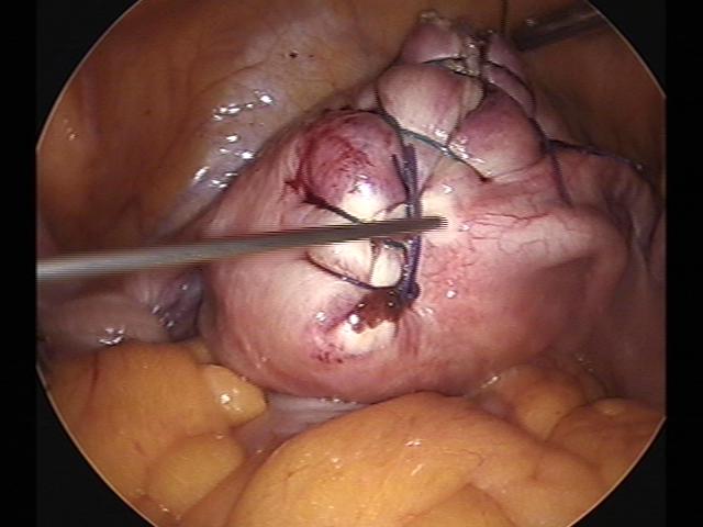 myomectomy (6)(2).jpg