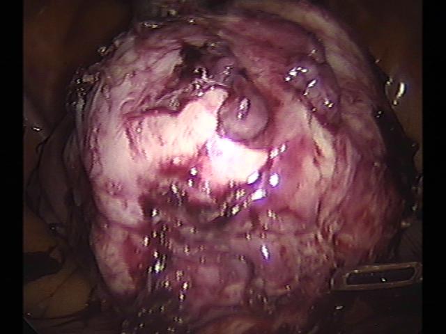 myomectomy (6)(4).jpg