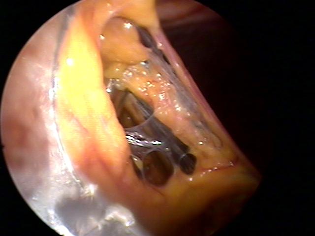 pelvic mass (2).jpg