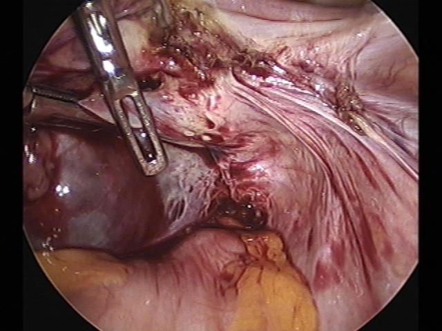 rt oophorectomy (2).jpg
