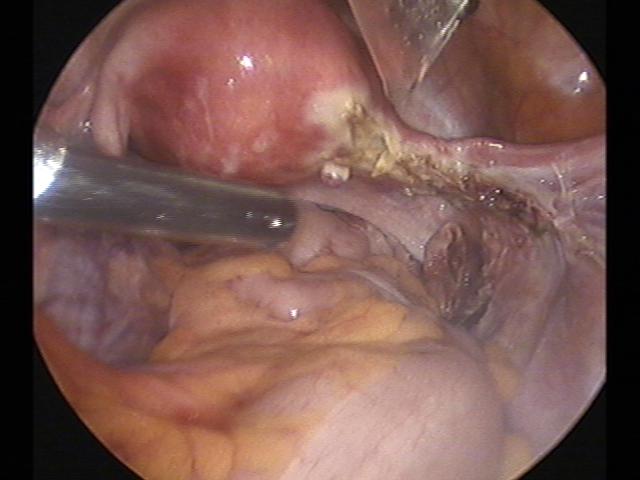 rt oophorectomy (3).jpg